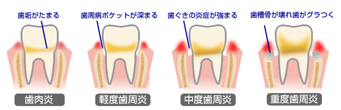 歯周病症状の図